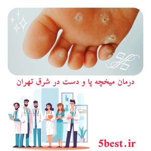 درمان میخچه پا و دست در شرق تهران