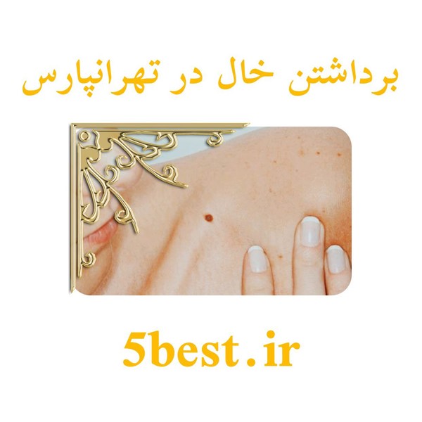 برداشتن خال در تهرانپارس
