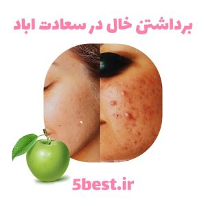 برداشتن خال در سعادت اباد