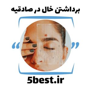 برداشتن خال در صادقیه