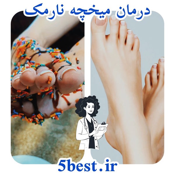درمان میخچه نارمک