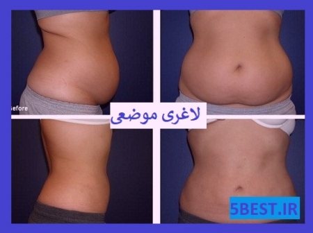 لاغری موضعی عگس قبل و بعد شکم