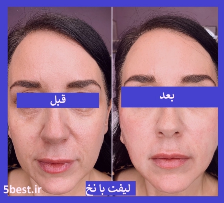 نخ امبدینگ لاغری در پیروزی