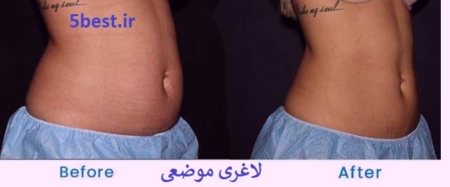  لاغری با نخ امبدینگ در تهرانپارس
