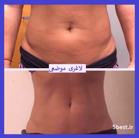  لاغری با نخ امبدینگ در تهرانپارس