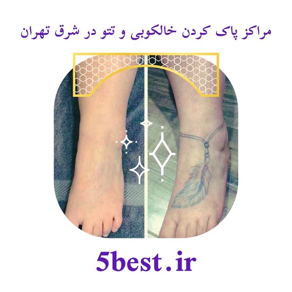مراکز پاک کردن خالکوبی و تتو در شرق تهران