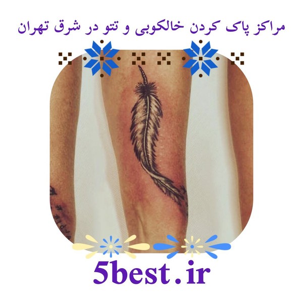 مراکز پاک کردن خالکوبی و تتو در شرق تهران