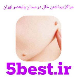 مراکز برداشتن خال در میدان ولیعصر تهران