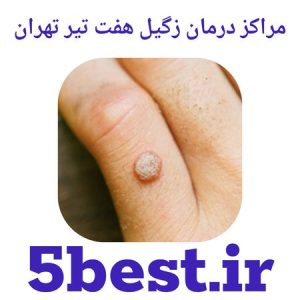 مراکز درمان زگیل هفت تیر تهران