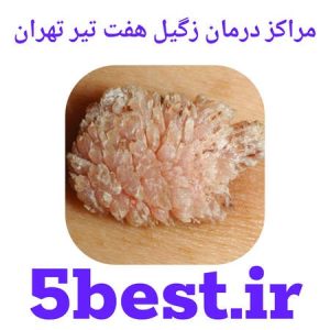 مراکز درمان زگیل هفت تیر تهران