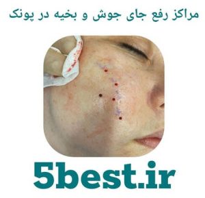 مراکز رفع جای جوش و بخیه در پونک
