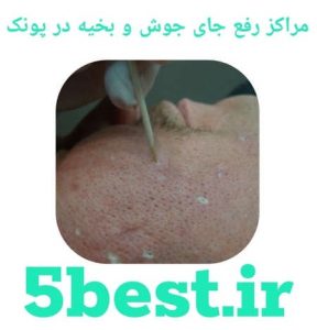 مراکز رفع جای جوش و بخیه در پونک
