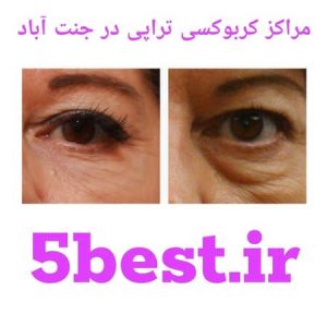 مراکز کربوکسی تراپی پونک
