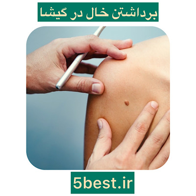 برداشتن خال در گیشا