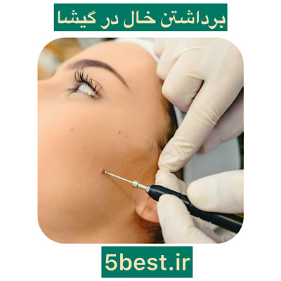 برداشتن خال در گیشا