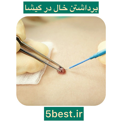برداشتن خال در گیشا