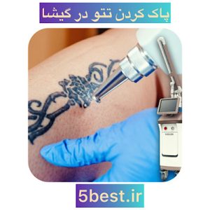 پاک کردن تتو در گیشا