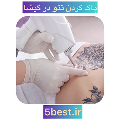 پاک کردن تتو در گیشا