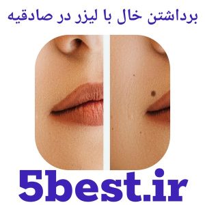 برداشتن خال با لیزر در صادقیه