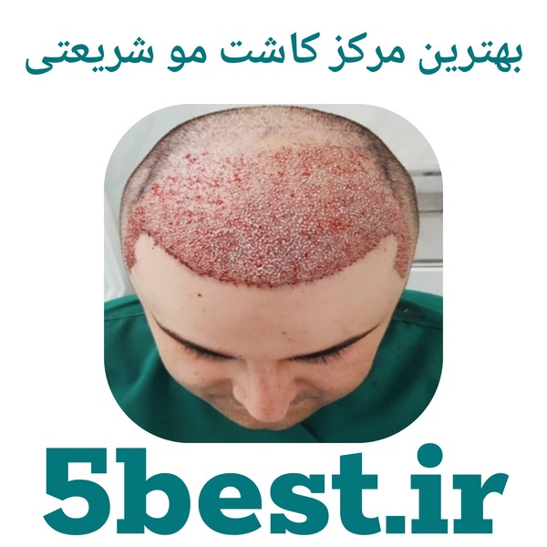 بهترین مرکز کاشت مو شریعتی