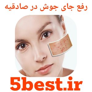 رفع جای جوش در صادقیه