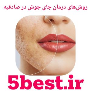 روش‌های درمان جای جوش در صادقیه