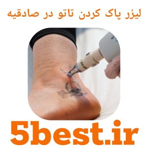 لیزر پاک کردن تاتو در صادقیه