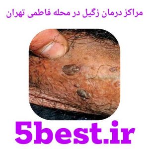 مراکز درمان زگیل در محله فاطمی تهران
