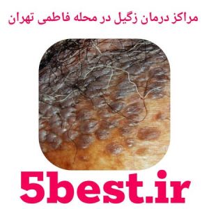 مراکز درمان زگیل در محله فاطمی تهران
