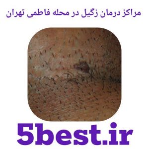 مراکز درمان زگیل در محله فاطمی تهران