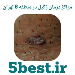 مراکز درمان زگیل در منطقه 6 تهران