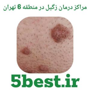 مراکز درمان زگیل در منطقه 6 تهران