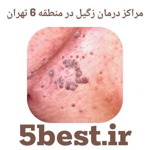 مراکز درمان زگیل در منطقه 6 تهران