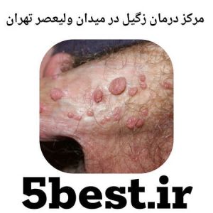 مراکز درمان زگیل در میدان ولیعصر تهران