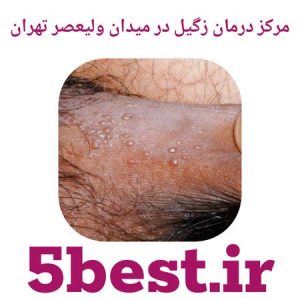 مراکز درمان زگیل در میدان ولیعصر تهران