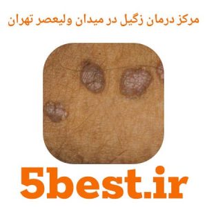 مراکز درمان زگیل در میدان ولیعصر تهران
