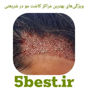 ویژگی‌های بهترین مراکز کاشت مو در شریعتی