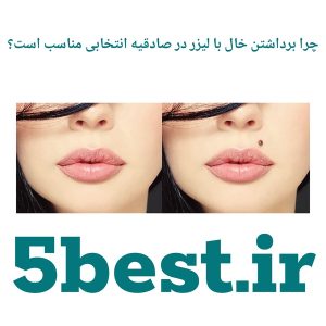 چرا برداشتن خال با لیزر در صادقیه انتخابی مناسب است؟