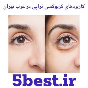 کاربردهای کربوکسی تراپی در غرب تهران