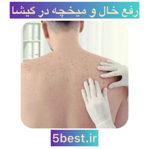 رفع خال و میخچه در گیشا