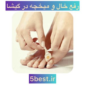رفع خال و میخچه در گیشا