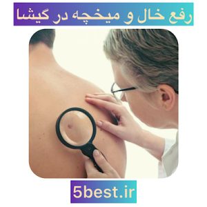 رفع خال و میخچه در گیشا