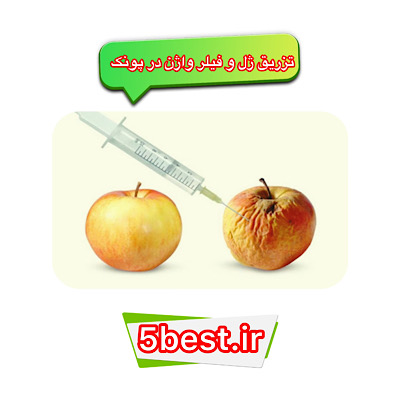 تزریق ژل و فیلر واژن در پونک