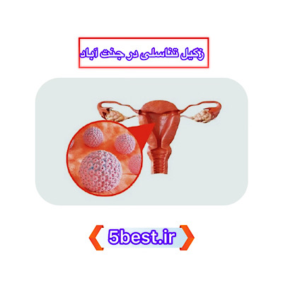 زگیل تناسلی در جنت آباد