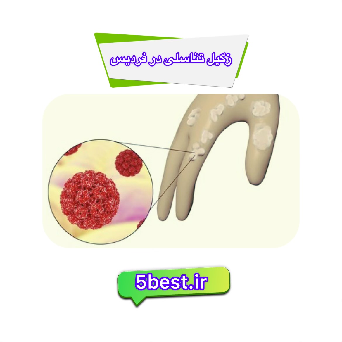زگیل تناسلی در فردیس