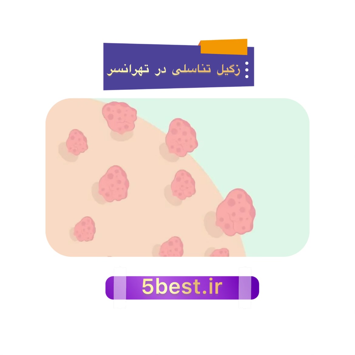 زگیل تناسلی در تهرانسر