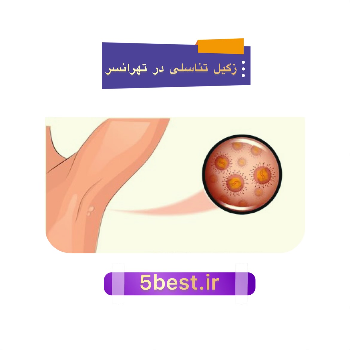 زگیل تناسلی در تهرانسر