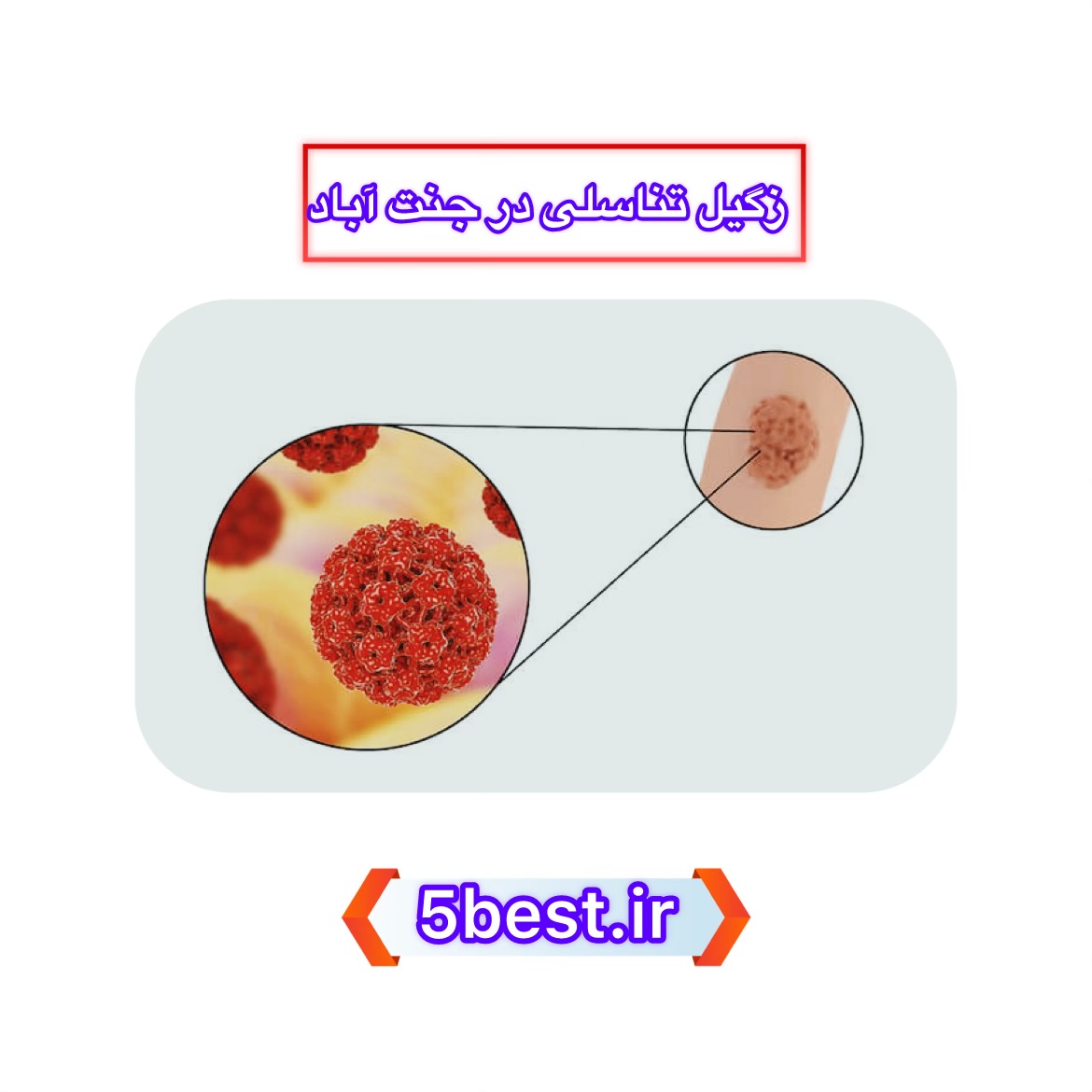 زگیل تناسلی در جنت آباد