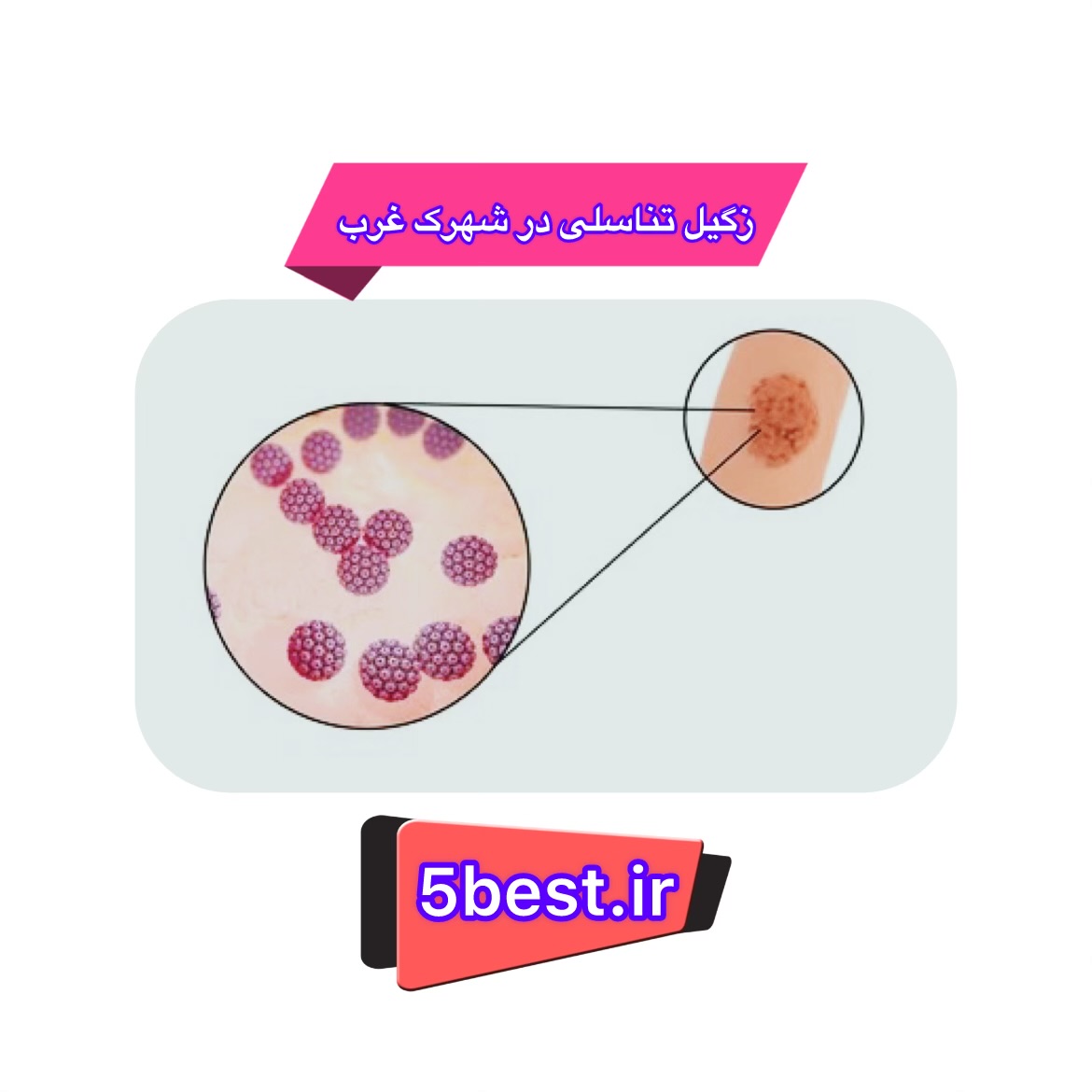 زگیل تناسلی شهرک غرب 