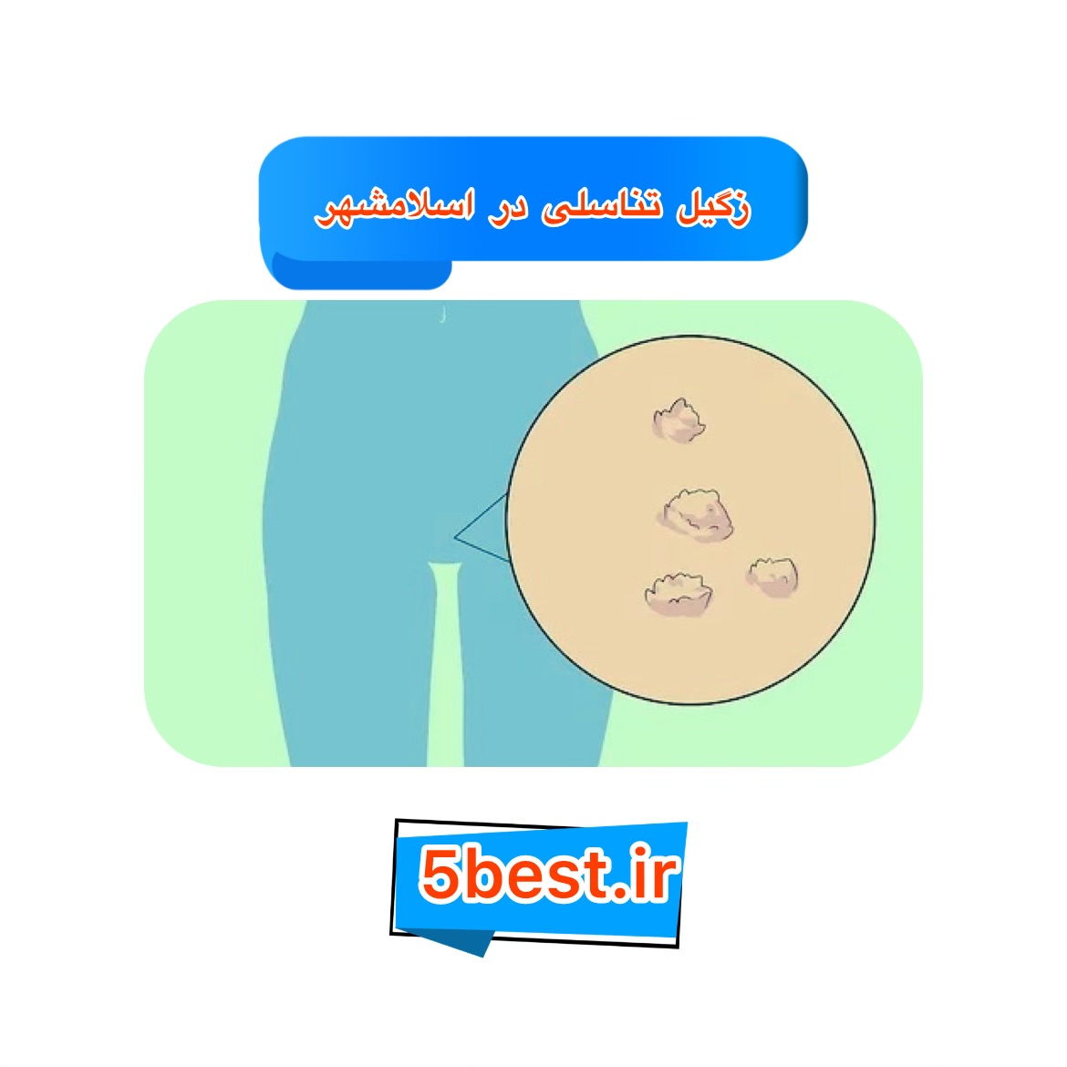 زگیل تناسلی در اسلامشهر